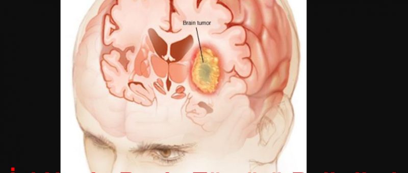 beyin-tumoru-nasil-olusur