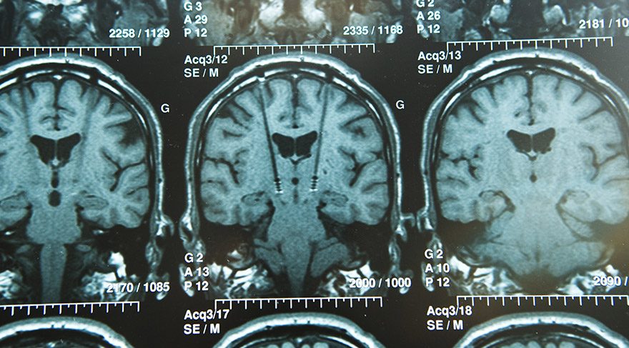 beyin-tumoru-tedavi-yontemleri
