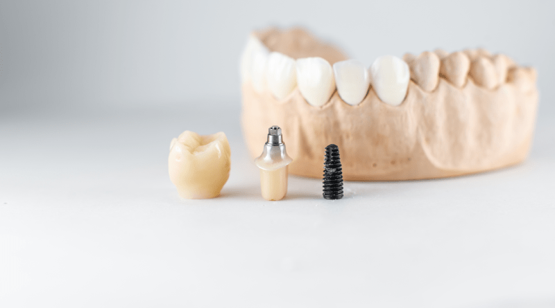 diş implant süreci diş implantı tedavisi