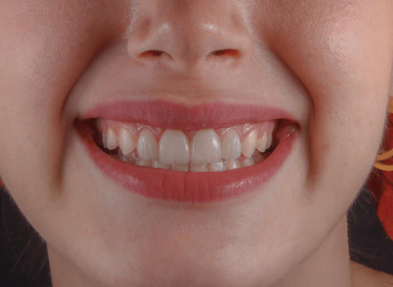 Diş Tedavisi 