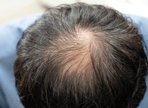 Androgenetik Alopesinin (Erkek Tipi Kellik) Kapsamlı Bir İncelemesi